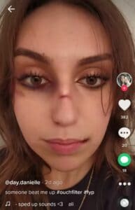 ouch bruised face filter tiktok